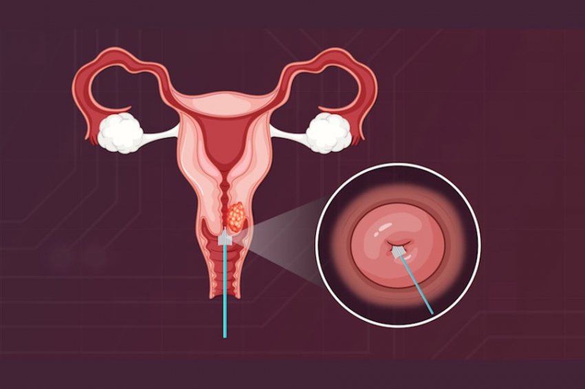 Microorganisms: анализ мочи заранее и точно выявит риск рака шейки матки