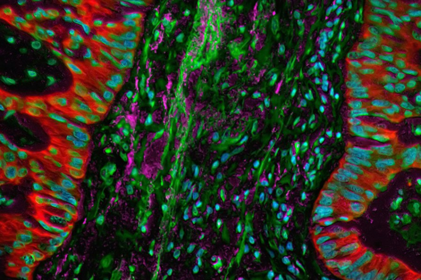 Ученые обнаружили, что особые иммунные клетки останавливают метастатический рак