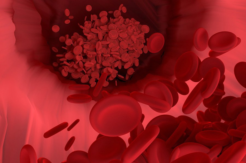 Ученые объяснили, как высокий уровень сахара в крови увеличивает риск тромбоза
