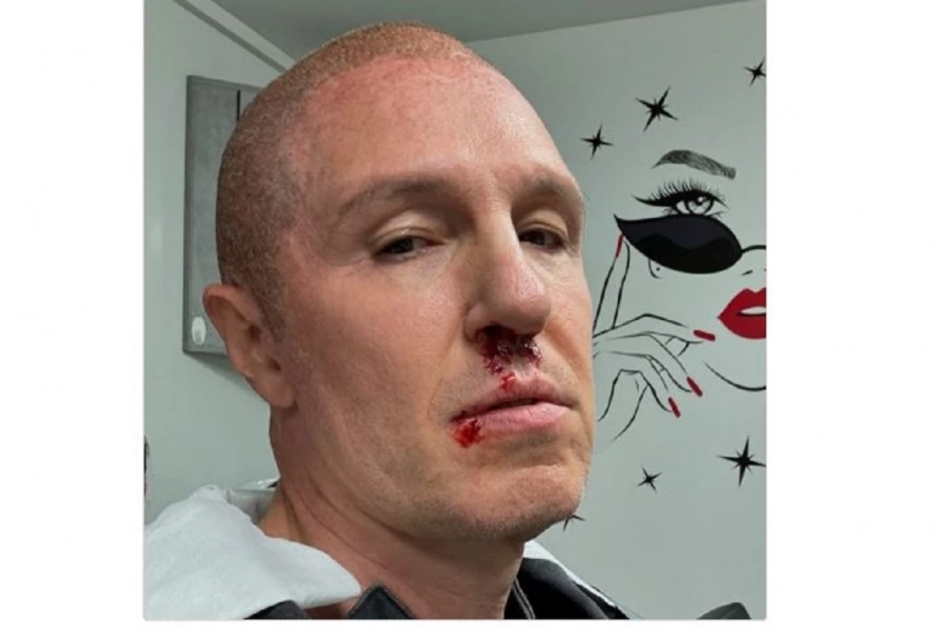 «Психанул»: Актер Игорь Верник показался на фото с разбитым носом и губой