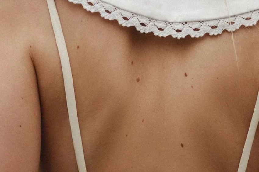 Сиднейские учёные раскрыли влияние толщины опухоли при меланоме на смертность
